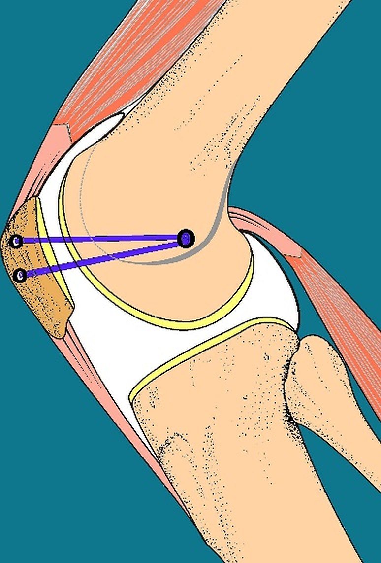 Drawing of the knee from the side, showing the patella and its stabilising ligament